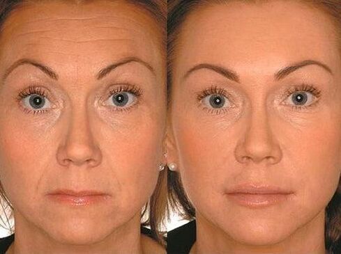 Before and after microharmber therapy