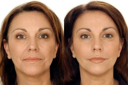 LPG facial massage before and after