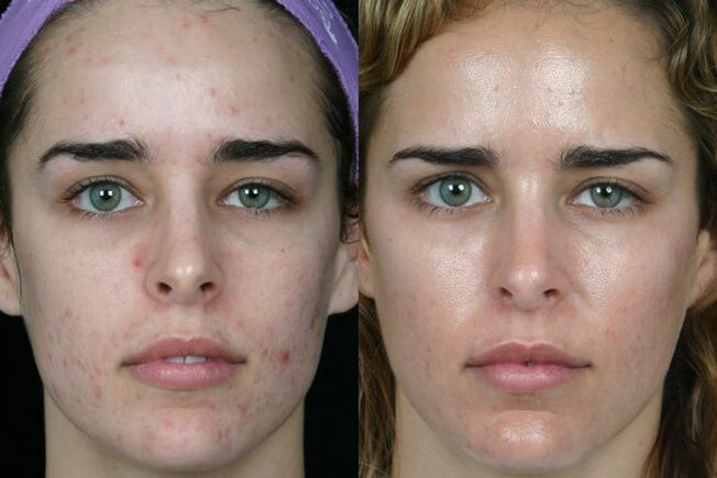 Laser grinding facial leather before and after